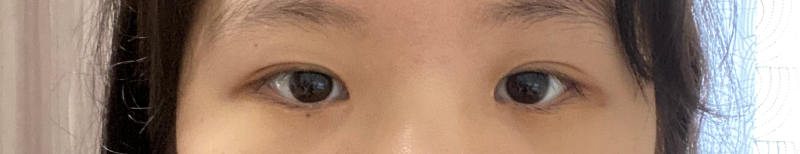 Partial incision double eyelid + front slit + non-incision eyelid correction 6 months review