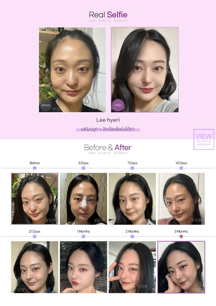 เสริมจมูก + จัดเรียงไขมันใต้ตา