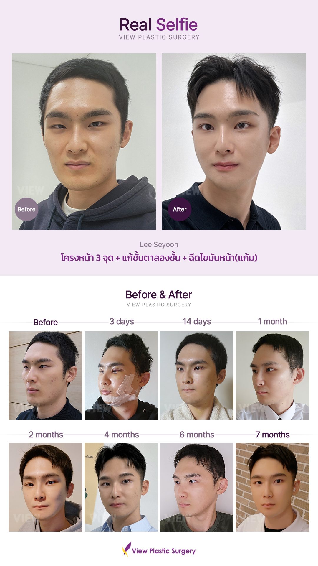 โครงหน้า 3 จุด + แก้ชั้นตาสองชั้น + ฉีดไขมันหน้า(แก้ม)