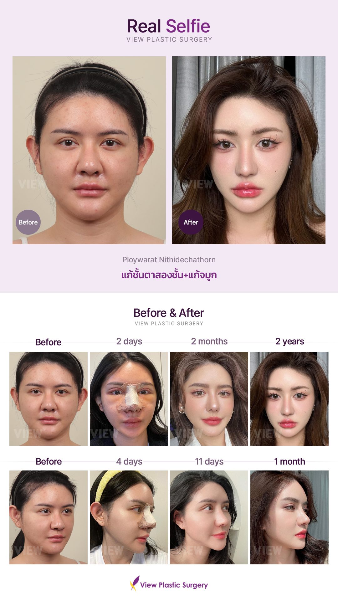 แก้ชั้นตาสองชั้น+แก้จมูก
