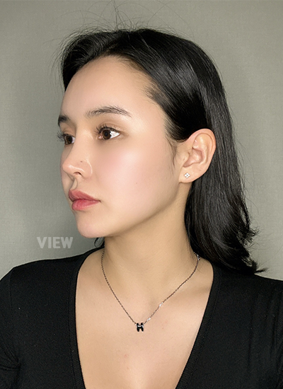 รีวิวโรงพยาบาลศัลยกรรมวิว,ศัลยกรรมจมูกเกาหลี,ผ่าตัดศัลยกรรมจมูก,ศัลยกรรมโครงหน้าเกาหลี,ผ่าตัดศัลยกรรมโครงหน้า