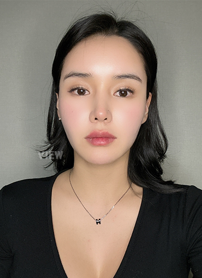 รีวิวโรงพยาบาลศัลยกรรมวิว,ศัลยกรรมจมูกเกาหลี,ผ่าตัดศัลยกรรมจมูก,ศัลยกรรมโครงหน้าเกาหลี,ผ่าตัดศัลยกรรมโครงหน้า