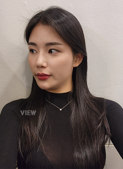 รีวิวโรงพยาบาลศัลยกรรมวิว, ฉีดไขมัน, โครงหน้า, ปรึกษาโครงหน้า, รีวิวการฉีดไขมัน, รีวิวการผ่าตัดโครงหน้า