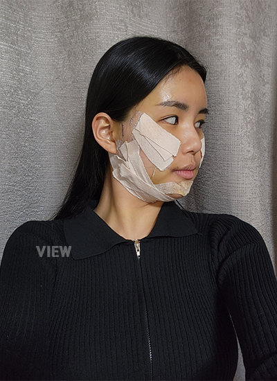 รีวิวครบ 4 วันของการผ่าตัดโครงหน้า, รีวิวครบ 3 วันของการฉีดไขมัน, การดูแลตัวเองหลังผ่าตัด, ข้อควรระวังหลังผ่าตัด