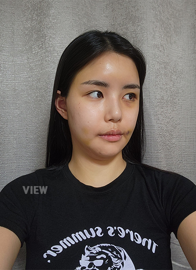 รีวิวครบ 7วันของการผ่าตัดโครงหน้า, การตัดไหมของการผ่าตัดโครงหน้า, รีวิวครบ 7 วันของการฉีดไขมัน