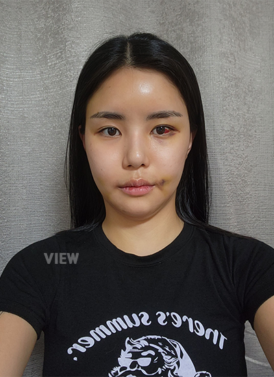 รีวิวครบ 7วันของการผ่าตัดโครงหน้า, การตัดไหมของการผ่าตัดโครงหน้า, รีวิวครบ 7 วันของการฉีดไขมัน