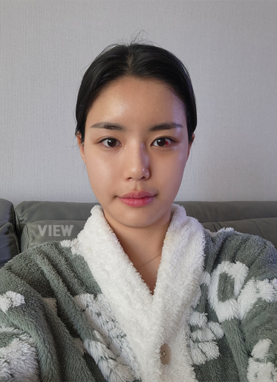 รีวิวครบ 14 วันของการผ่าตัดโครงหน้า, รีวิวครบ 14 วันของการผ่าตัดแก้จมูก, การดูแลหลังผ่าตัด 2อาทิตย์