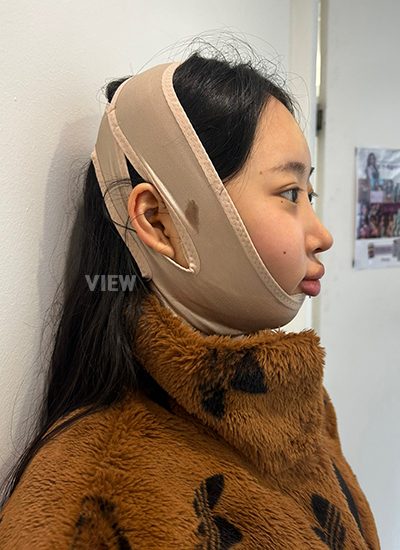 รีวิวหลังผ่าตัดโครงหน้าวันที่ 3,การดูแลหลังผ่าตัด,ข้อควรระวังหลังผ่าตัด