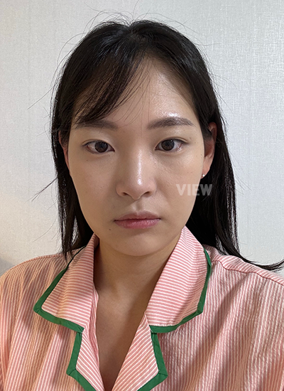 ใช้กระดูกอ่อนซี่โครงตัวเอง 
