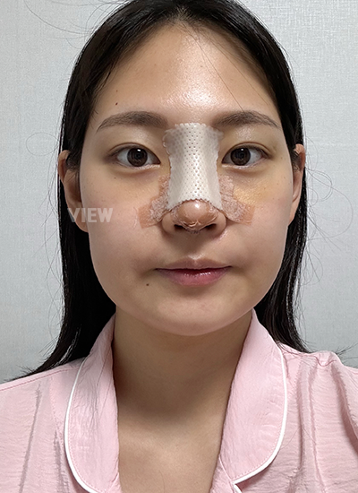 เหลาฐานจมูก  รีวิวโรงพยาบาลศัลยกรรมวิว,ศัลยกรรมจมูกเกาหลี,ผ่าตัดศัลยกรรมจมูก,ศัลยกรรมโครงหน้าเกาหลี,ผ่าตัดศัลยกรรมโครงหน้า 