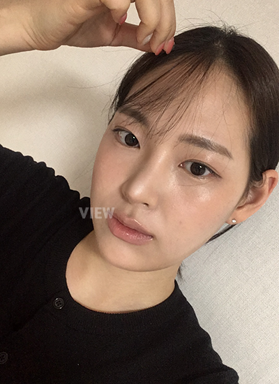 ลดขนาดจมูกโดยนำเนื้อส่วนเกินออก 
