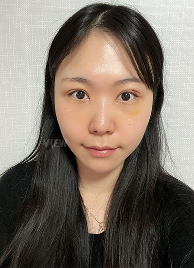 รีวิวโรงพยาบาลศัลยกรรมวิว,ศัลยกรรมจมูกเกาหลี,ผ่าตัดศัลยกรรมจมูก,ศัลยกรรมโครงหน้าเกาหลี,ผ่าตัดศัลยกรรมโครงหน้า 