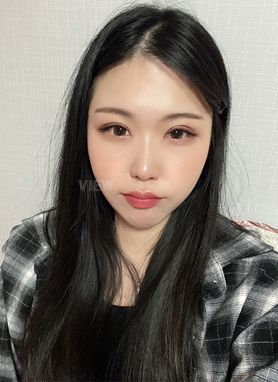 รีวิว 4 อาทิตย์หลังทำตาสองชั้น, วิธีดูแลหลังการผ่าตัดศัลยกรรมตา,และข้อควรระวัง, โรงพยาบาลวิว, เกาหลี, ศัลยกรรมตา,การเปิดหัวตา,การเปิดหางตา,การเปิดใต้ตา