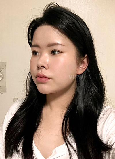 รีวิว, ก่อนแก้ตาสองชั้นเกาหลี, รูปก่อนหลังทำศัลยกรรม, เปิดหัวตาเกาหลี,เสริมจมูก, ดูดไขมันเหนียง, ตาสองชั้นสวยๆ, โรงพยาบาลวิว, ศัลยกรรมเกาหลี