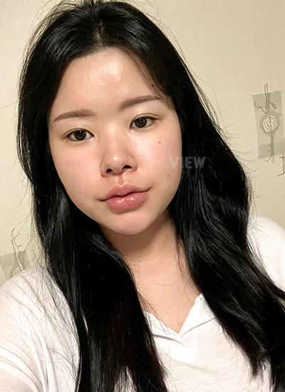 รีวิว, ก่อนแก้ตาสองชั้นเกาหลี, รูปก่อนหลังทำศัลยกรรมตา, เปิดหัวตาเกาหลี, ระเบิดตา, เปิดตา, ตาสองชั้นสวยๆ, โรงพยาบาลวิว, ศัลยกรรมเกาหลี