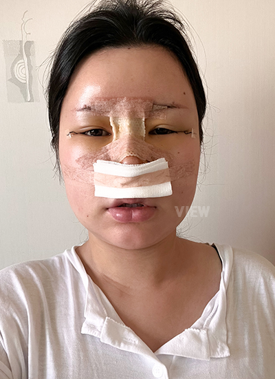 รีวิว, แก้ตาสองชั้นเกาหลี, รูปก่อนหลังทำศัลยกรรม, เปิดหัวตาเกาหลี,เสริมจมูก, ดูดไขมันเหนียง, ตาสองชั้นสวยๆ, โรงพยาบาลวิว, ศัลยกรรมเกาหลี