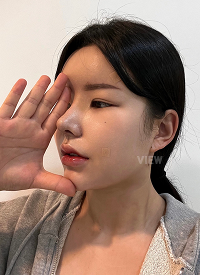 รีวิว 7 วัน, แก้ตาสองชั้นเกาหลี, รูปก่อนหลังทำศัลยกรรม, เปิดหัวตาเกาหลี,เสริมจมูก, ดูดไขมันเหนียง, ตาสองชั้นสวยๆ, โรงพยาบาลวิว, ศัลยกรรมเกาหลี