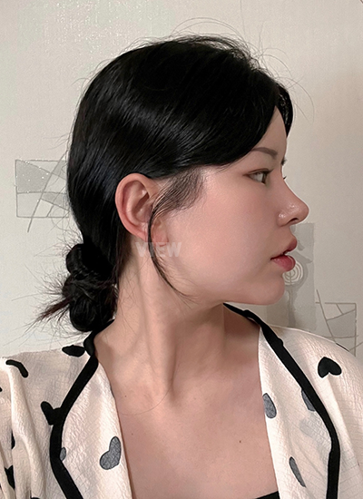 รีวิว 7 วัน, แก้ตาสองชั้นเกาหลี, รูปก่อนหลังทำศัลยกรรม, เปิดหัวตาเกาหลี,เสริมจมูก, ดูดไขมันเหนียง, ตาสองชั้นสวยๆ, โรงพยาบาลวิว, ศัลยกรรมเกาหลี