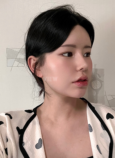 รีวิว 7 วัน, แก้ตาสองชั้นเกาหลี, รูปก่อนหลังทำศัลยกรรม, เปิดหัวตาเกาหลี,เสริมจมูก, ดูดไขมันเหนียง, ตาสองชั้นสวยๆ, โรงพยาบาลวิว, ศัลยกรรมเกาหลี