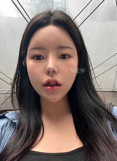 รีวิว 1 เดือน, แก้ตาสองชั้นเกาหลี, รูปก่อนหลังทำศัลยกรรม, เปิดหัวตาเกาหลี,เสริมจมูก, ดูดไขมันเหนียง, ตาสองชั้นสวยๆ, โรงพยาบาลวิว, ศัลยกรรมเกาหลี