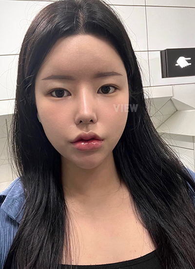 รีวิว 1 เดือน, แก้ตาสองชั้นเกาหลี, รูปก่อนหลังทำศัลยกรรม, เปิดหัวตาเกาหลี,เสริมจมูก, ดูดไขมันเหนียง, ตาสองชั้นสวยๆ, โรงพยาบาลวิว, ศัลยกรรมเกาหลี