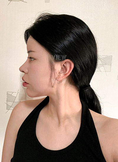 รีวิว 1 เดือน, แก้ตาสองชั้นเกาหลี, รูปก่อนหลังทำศัลยกรรม, เปิดหัวตาเกาหลี,เสริมจมูก, ดูดไขมันเหนียง, ตาสองชั้นสวยๆ, โรงพยาบาลวิว, ศัลยกรรมเกาหลี