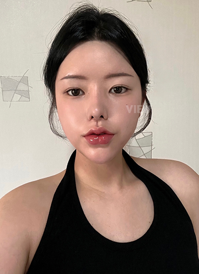 รีวิว 1 เดือน, แก้ตาสองชั้นเกาหลี, รูปก่อนหลังทำศัลยกรรม, เปิดหัวตาเกาหลี,เสริมจมูก, ดูดไขมันเหนียง, ตาสองชั้นสวยๆ, โรงพยาบาลวิว, ศัลยกรรมเกาหลี