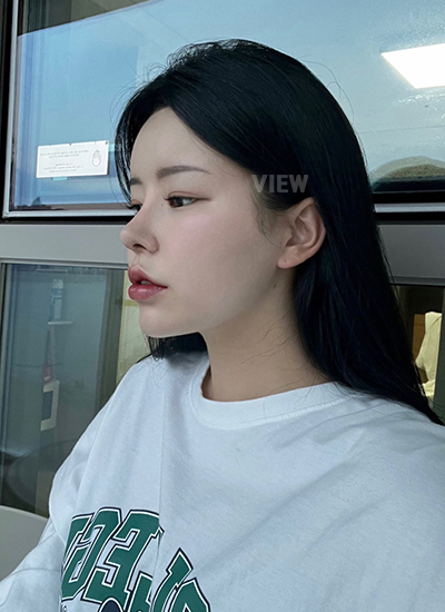 รีวิวครบ 3 เดือนของการทำศัลยกรรมแก้จมูกและโครงหน้า, การล้างแผล, การดูแลหลังผ่าตัด, ข้อห้ามหลังทำศัลยกรรม, เกาหลี