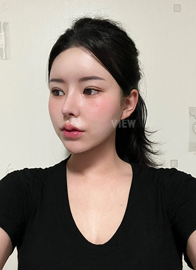 รีวิว 4 เดือน, แก้ตาสองชั้นเกาหลี, รูปก่อนหลังทำศัลยกรรม, เปิดหัวตาเกาหลี,เสริมจมูก, ดูดไขมันเหนียง, ตาสองชั้นสวยๆ, โรงพยาบาลวิว, ศัลยกรรมเกาหลี