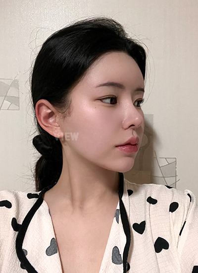 รีวิว 2 เดือน, แก้ตาสองชั้นเกาหลี, รูปก่อนหลังทำศัลยกรรม, เปิดหัวตาเกาหลี,เสริมจมูก, ดูดไขมันเหนียง, ตาสองชั้นสวยๆ, โรงพยาบาลวิว, ศัลยกรรมเกาหลี