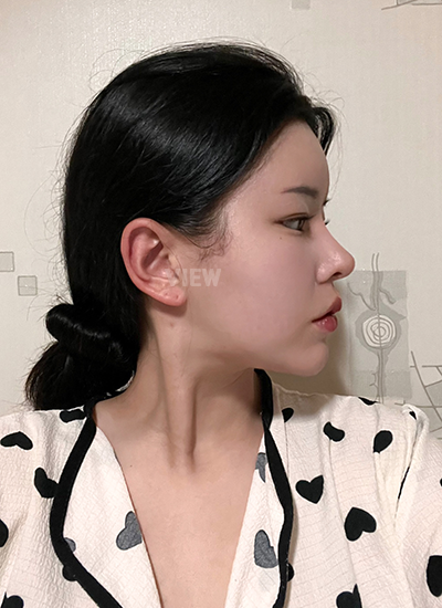 รีวิว 1 เดือน, แก้ตาสองชั้นเกาหลี, รูปก่อนหลังทำศัลยกรรม, เปิดหัวตาเกาหลี,เสริมจมูก, ดูดไขมันเหนียง, ตาสองชั้นสวยๆ, โรงพยาบาลวิว, ศัลยกรรมเกาหลี