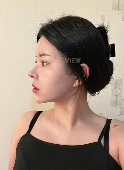 รีวิว 8 เดือน, แก้ตาสองชั้นเกาหลี, รูปก่อนหลังทำศัลยกรรม, เปิดหัวตาเกาหลี,เสริมจมูก, ดูดไขมันเหนียง, ตาสองชั้นสวยๆ, โรงพยาบาลวิว, ศัลยกรรมเกาหลี