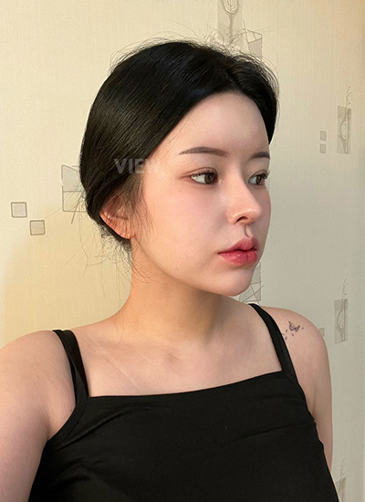 รีวิว 8 เดือน, แก้ตาสองชั้นเกาหลี, รูปก่อนหลังทำศัลยกรรม, เปิดหัวตาเกาหลี,เสริมจมูก, ดูดไขมันเหนียง, ตาสองชั้นสวยๆ, โรงพยาบาลวิว, ศัลยกรรมเกาหลี