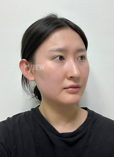 รีวิวโรงพยาบาลศัลยกรรมวิว, ศัลยกรรมจมูก เกาหลี, ศัลยกรรมจมูก, ประเภทของซิลิโคนจมูก 