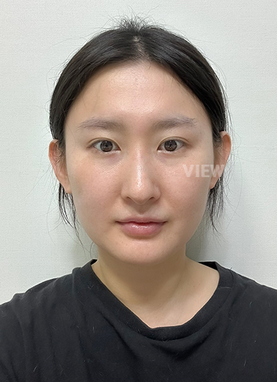 รีวิวโรงพยาบาลศัลยกรรมวิว, ศัลยกรรมจมูก เกาหลี, ศัลยกรรมจมูก, ประเภทของซิลิโคนจมูก 