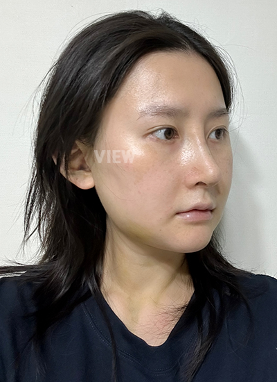 รีวิวศัลยกรรมจมูก, การดูแลหลังศัลยกรรมจมูก, ข้อควรระวังหลังศัลยกรรมโครงหน้า, หลังผ่าตัด 7 วัน, รีวิว