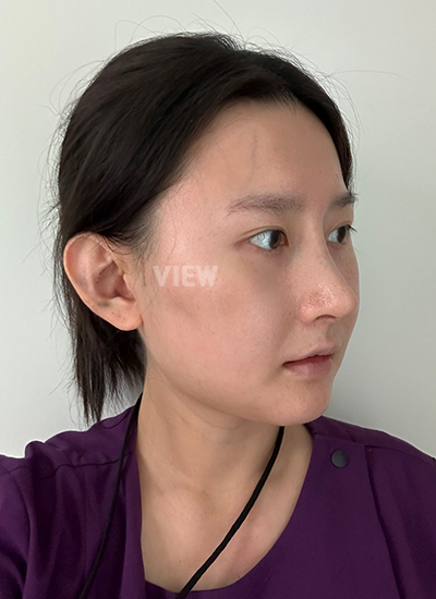 รีวิวศัลยกรรมจมูก, การดูแลหลังศัลยกรรมจมูก, ข้อควรระวังหลังศัลยกรรมจมูก, หลังผ่าตัด 2 อาทิตย์, รีวิว ฉีดไขมัน ปรับโครงหน้าเกาหลี