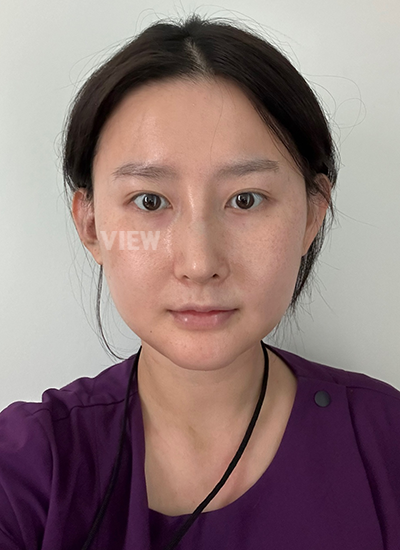 รีวิวศัลยกรรมจมูก, การดูแลหลังศัลยกรรมจมูก, ข้อควรระวังหลังศัลยกรรมจมูก, หลังผ่าตัด 2 อาทิตย์, รีวิว