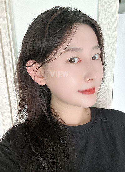 รีวิวศัลยกรรมจมูก, การดูแลหลังศัลยกรรมจมูก, ข้อควรระวังหลังศัลยกรรมจมูก, หลังผ่าตัด 2 เดือน, รีวิว ฉีดไขมัน ปรับโครงหน้าเกาหลี