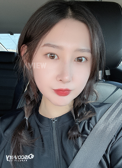 รีวิวศัลยกรรมจมูก, การดูแลหลังศัลยกรรมจมูก, ข้อควรระวังหลังศัลยกรรมจมูก, หลังผ่าตัด 2 เดือน, รีวิว ฉีดไขมัน ปรับโครงหน้าเกาหลี