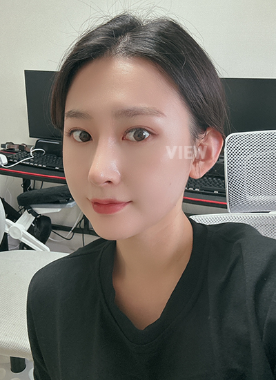 รีวิวศัลยกรรมจมูก, การดูแลหลังศัลยกรรมจมูก, ข้อควรระวังหลังศัลยกรรมจมูก, หลังผ่าตัด 5 เดือน, รีวิว ฉีดไขมัน ปรับโครงหน้าเกาหลี