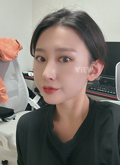 รีวิวศัลยกรรมจมูก, การดูแลหลังศัลยกรรมจมูก, ข้อควรระวังหลังศัลยกรรมจมูก, หลังผ่าตัด 5 เดือน, รีวิว ฉีดไขมัน ปรับโครงหน้าเกาหลี