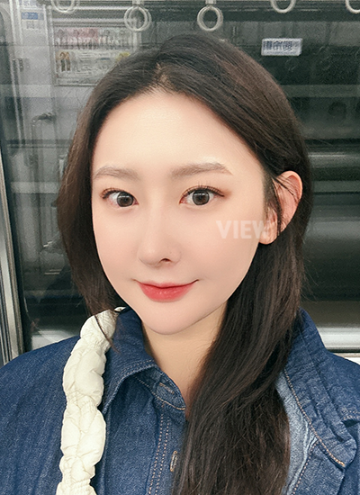 รีวิวศัลยกรรมจมูก, การดูแลหลังศัลยกรรมจมูก, ข้อควรระวังหลังศัลยกรรมจมูก, หลังผ่าตัด 4 เดือน, รีวิว ฉีดไขมัน ปรับโครงหน้าเกาหลี