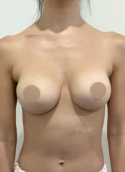 ริวิวโรงพยาบาลศัลยกรรมวิว, แก้หน้าอก, Mentor, ศัลยกรรมหน้าอก, รีวิวศัลยกรรมหน้าอกที่โรงพยาบาลศัลยกรรมวิว