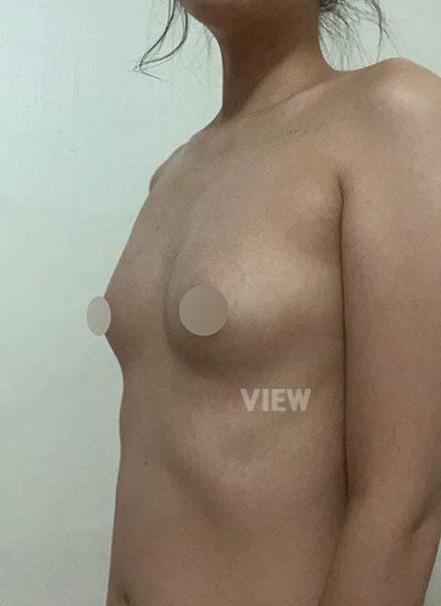 ริวิวโรงพยาบาลศัลยกรรมวิว, แก้หน้าอก, Sebbin, ศัลยกรรมหน้าอก, รีวิวศัลยกรรมหน้าอกที่โรงพยาบาลศัลยกรรมวิว