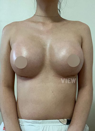 ริวิวโรงพยาบาลศัลยกรรมวิว, แก้หน้าอก, Sebbin, ศัลยกรรมหน้าอก, รีวิวศัลยกรรมหน้าอกที่โรงพยาบาลศัลยกรรมวิว