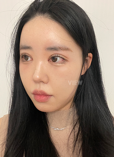 รีวิวครบ 14 วันของการผ่าตัดโครงหน้า, รีวิวครบ 14 วันของการผ่าตัดแก้จมูก, การดูแลหลังผ่าตัด 2อาทิตย์