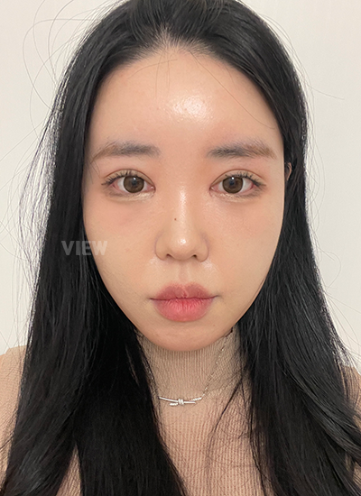รีวิวครบ 14 วันของการผ่าตัดโครงหน้า, รีวิวครบ 14 วันของการผ่าตัดแก้จมูก, การดูแลหลังผ่าตัด 2อาทิตย์