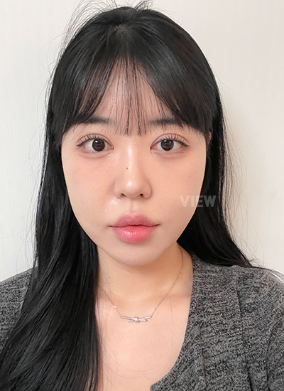 รีวิวครบ 14 วันของการผ่าตัดร้อยไหม, รีวิวครบ 21 วันของการผ่าตัดตาสองชั้น, การดูแลหลังผ่าตัด 3อาทิตย์