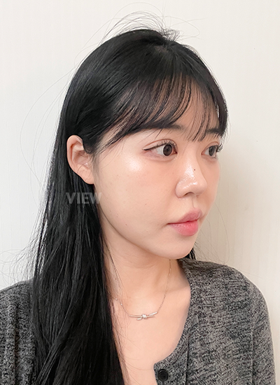 รีวิวครบ 14 วันของการผ่าตัดโครงหน้า, รีวิวครบ 21 วันของการผ่าตัดตาสองชั้น, การดูแลหลังผ่าตัด 3อาทิตย์